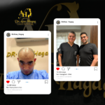 أسئلة و اجوبة عن زراعة الشعر