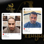 حل مشكلة فراغات الشعر للرجال