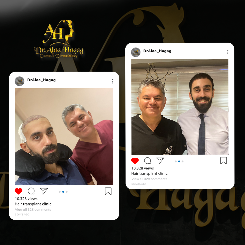 حل مشكلة فراغات الشعر للرجال
