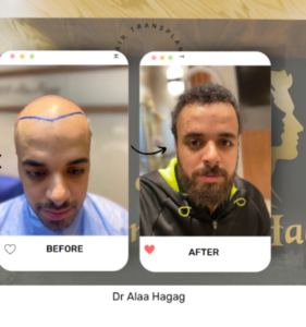 عملية زراعة الشعر في جدة