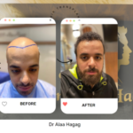 نصائح قبل عملية زراعة الشعر