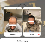 حل مشكلة فراغات الشعر للرجال