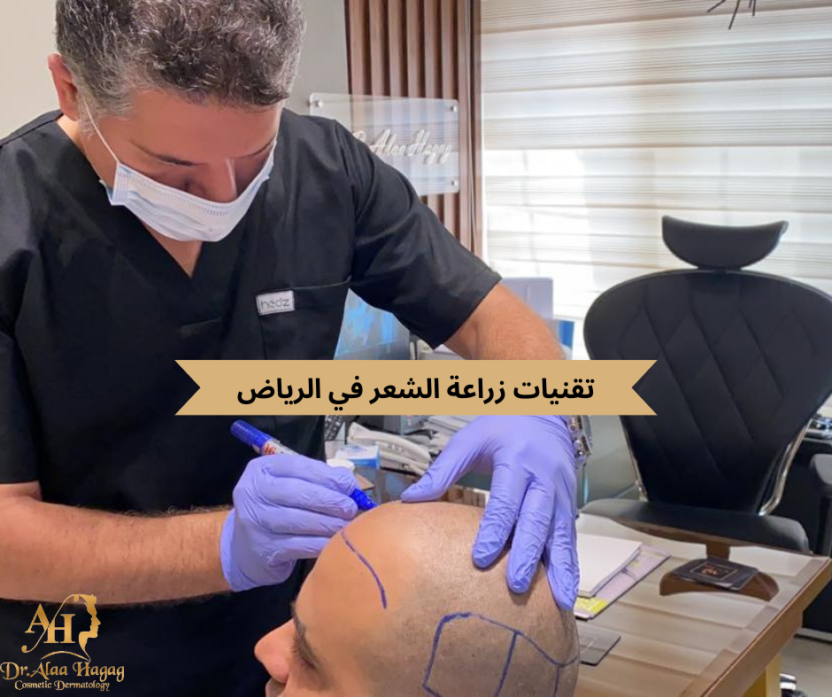 تقنيات زراعة الشعر في الرياض