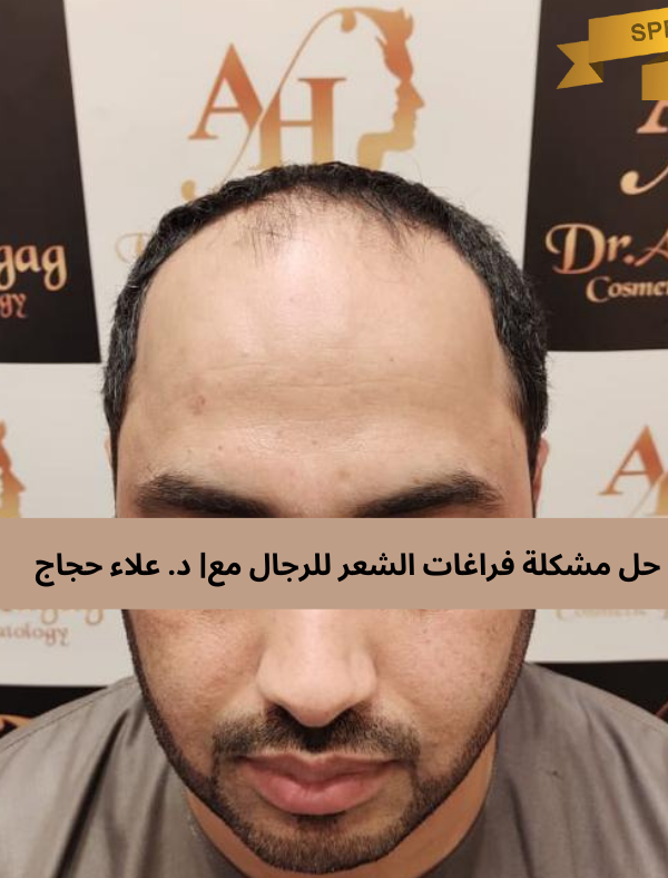 حل مشكلة فراغات الشعر للرجال