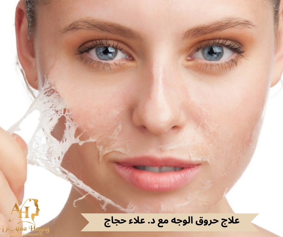 علاج حروق الوجه