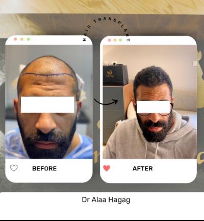 افضل تقنية لزراعة الشعر