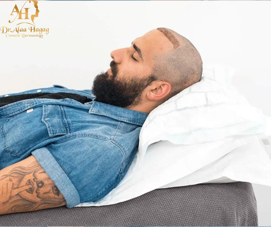 ممنوعات بعد زراعة الشعر