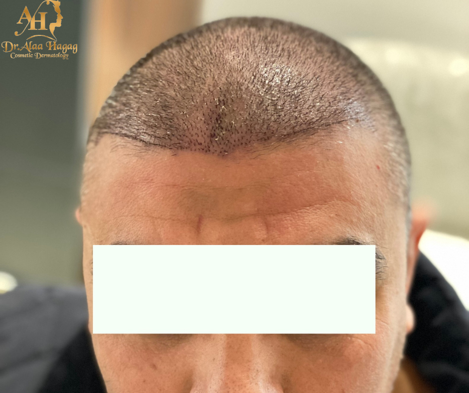 افضل تقنية لزراعة الشعر