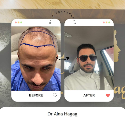 افضل تقنية لزراعة الشعر