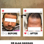 البوتكس للوجه