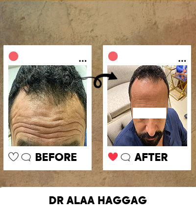البوتكس للوجه