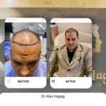 اسعار زراعة الشعر فى مصر