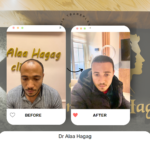 اسعار زراعة الشعر فى مصر