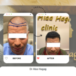 اسعار زراعة الشعر فى مصر