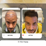 اسعار زراعة الشعر فى مصر