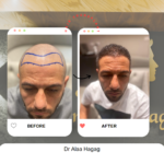 اسعار زراعة الشعر فى مصر