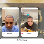 اسعار زراعة الشعر فى مصر