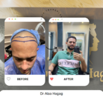 اسعار زراعة الشعر فى مصر