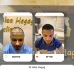 اسعار زراعة الشعر فى مصر