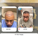 اسعار زراعة الشعر فى مصر