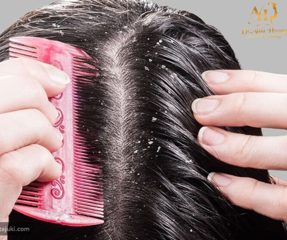 افضل علاج قشره الشعر