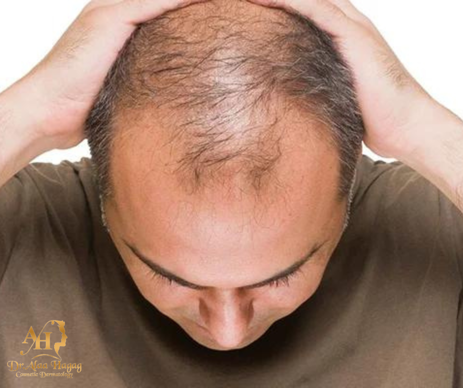 اسباب الصلع الوراثي