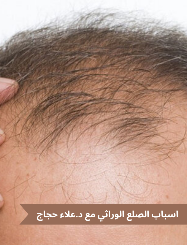 اسباب الصلع الوراثي