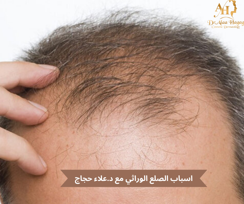 اسباب الصلع الوراثي