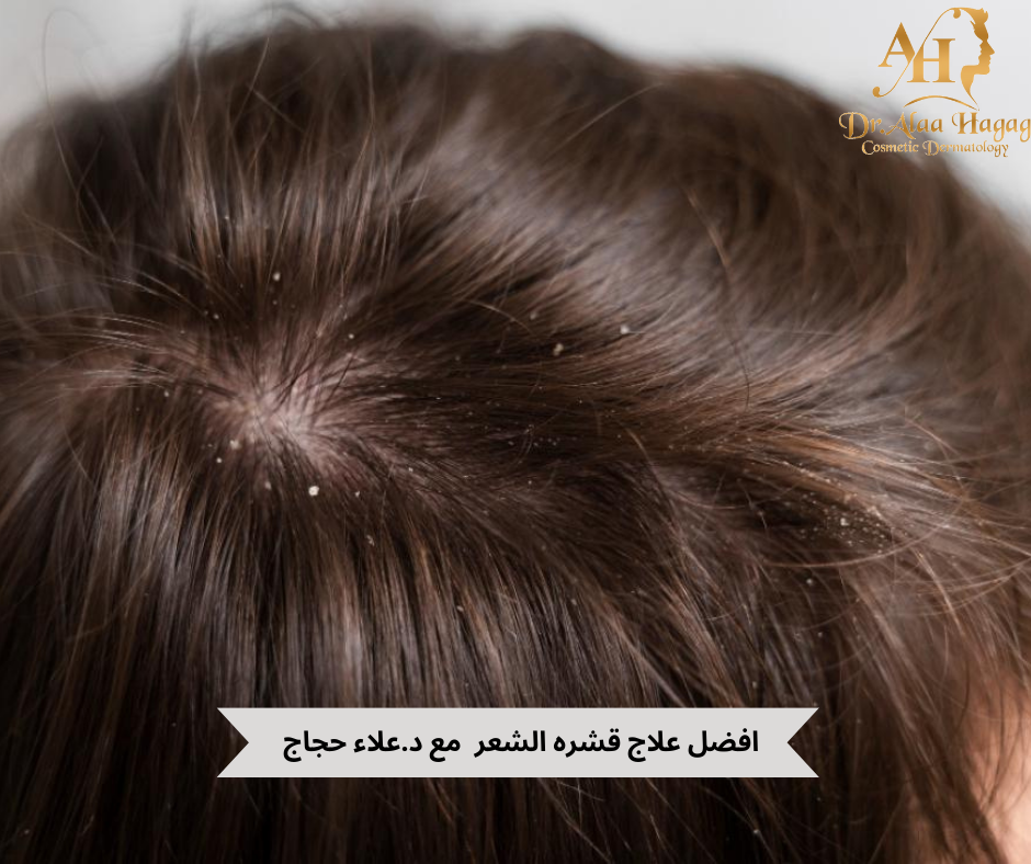 افضل علاج قشره الشعر