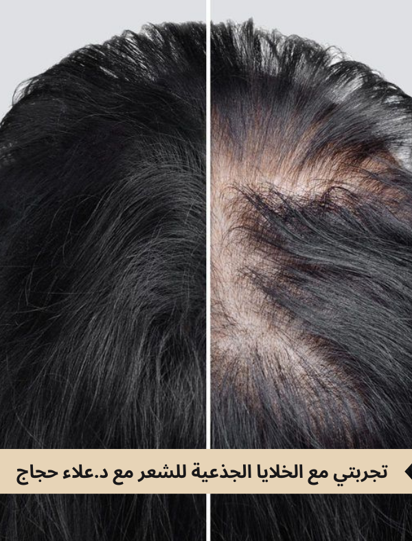 تجربتي مع الخلايا الجذعية للشعر