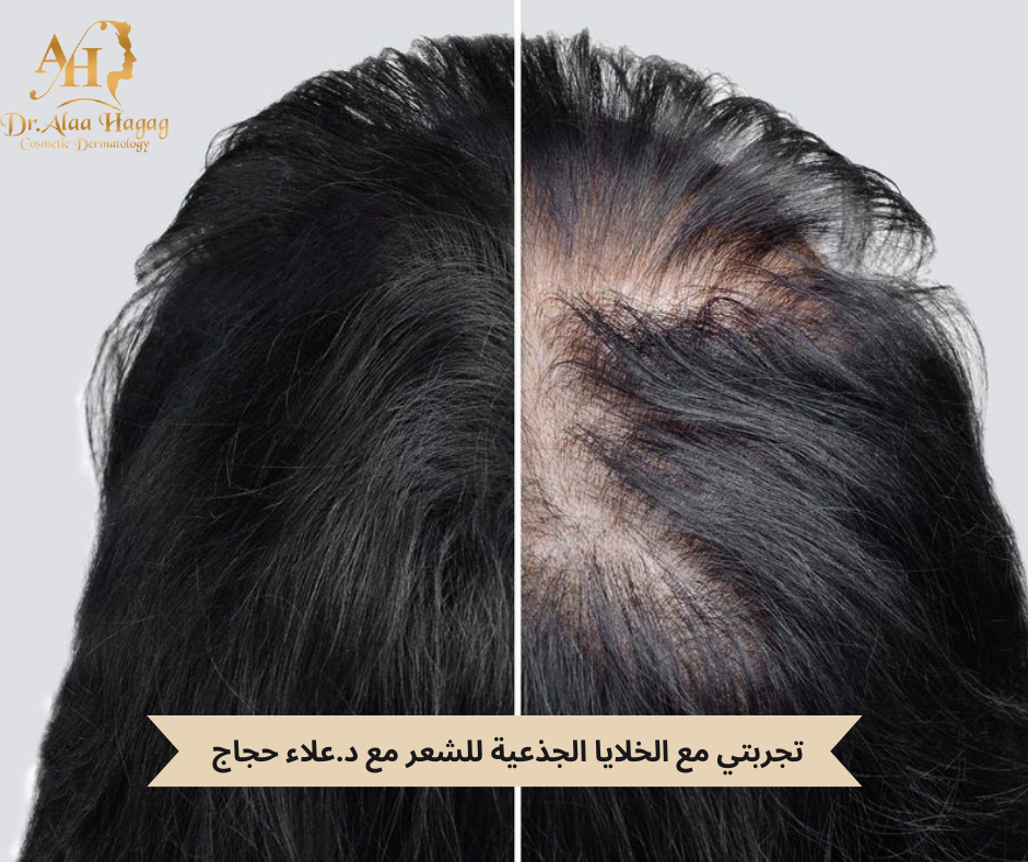 تجربتي مع الخلايا الجذعية للشعر