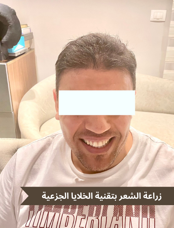 زراعة الشعر بتقنية الخلايا الجزعية