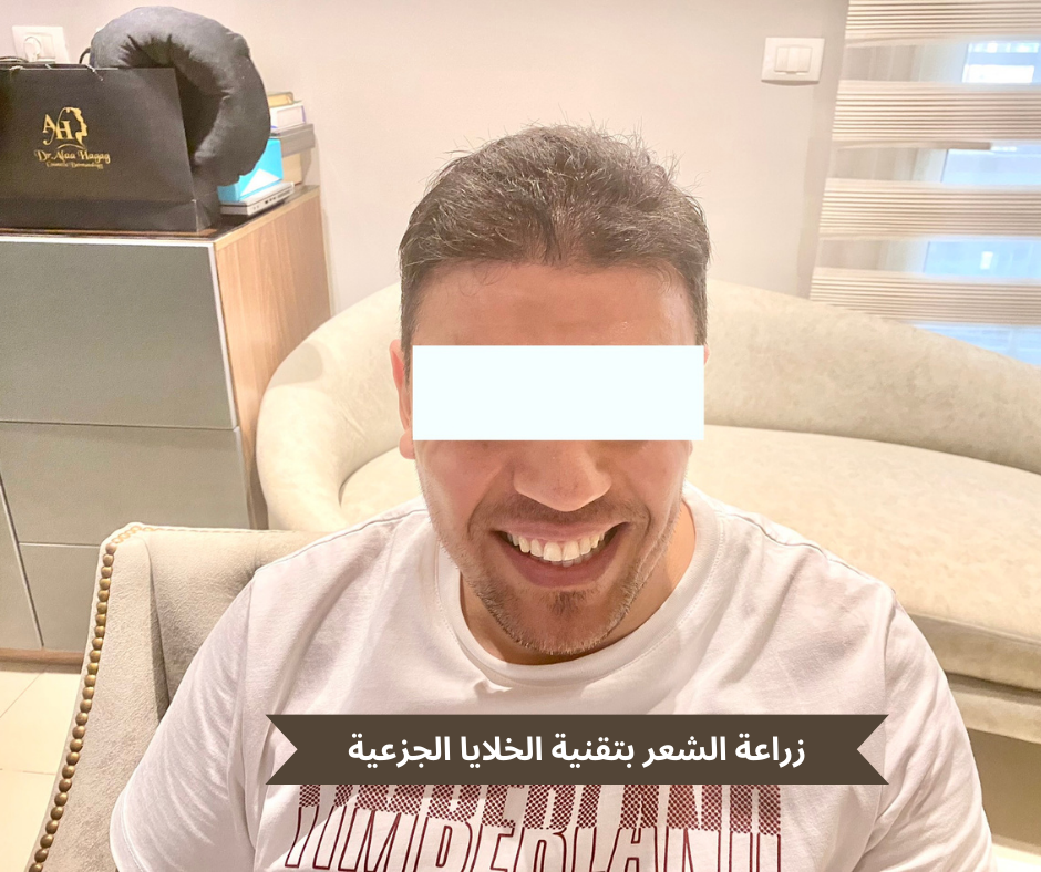 زراعة الشعر بتقنية الخلايا الجزعية