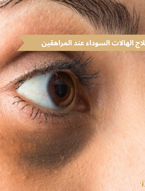 علاج الهالات السوداء عند المراهقين