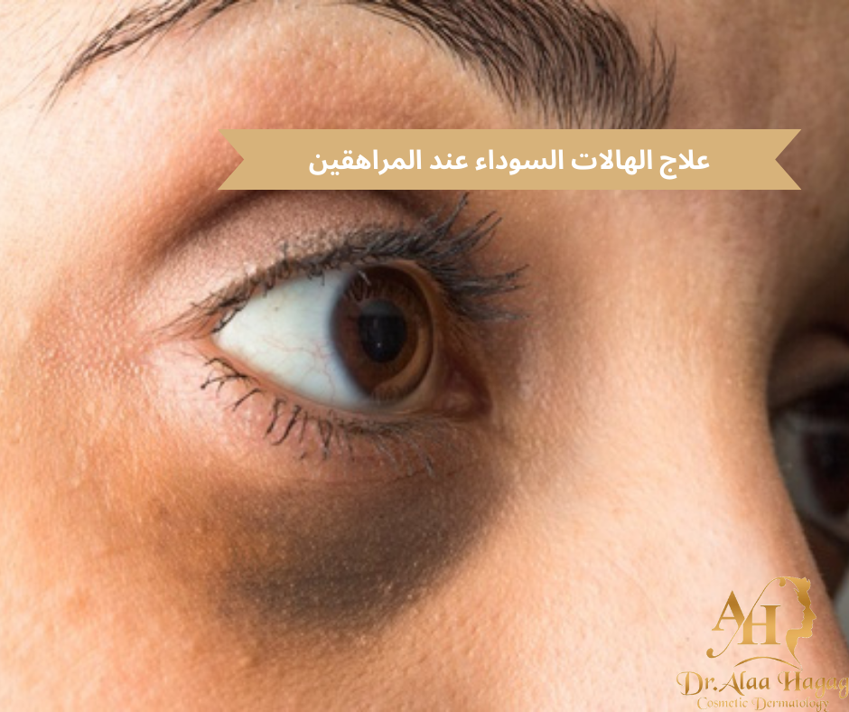 علاج الهالات السوداء عند المراهقين