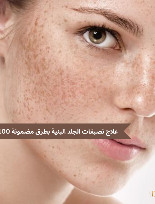 تصبغات الجلد البنية