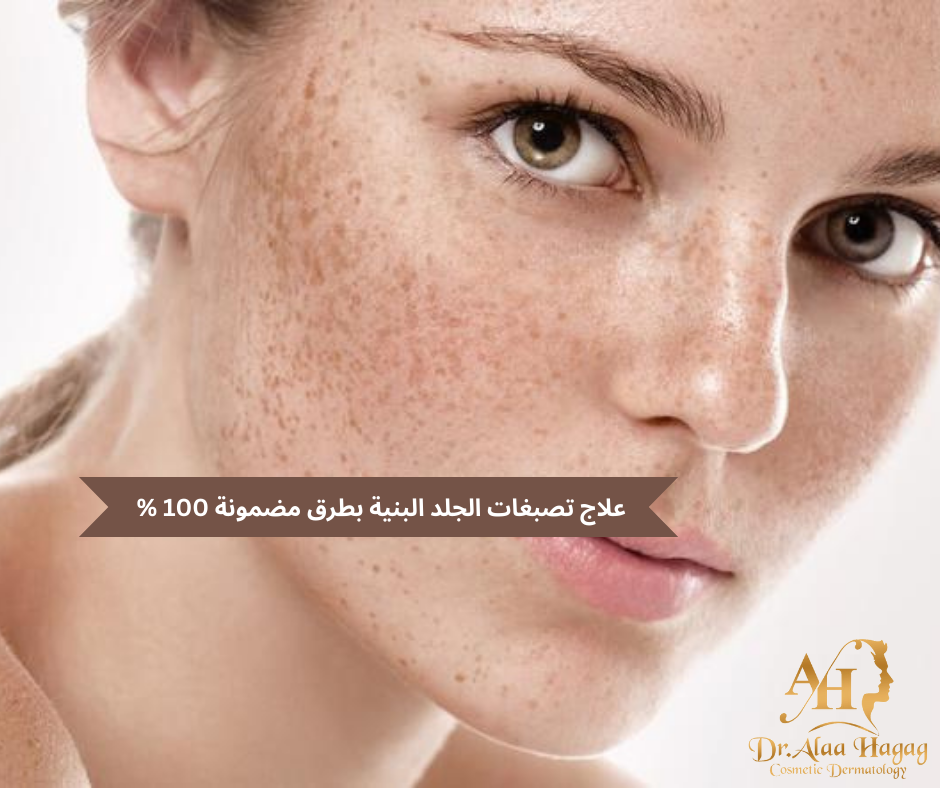 تصبغات الجلد البنية