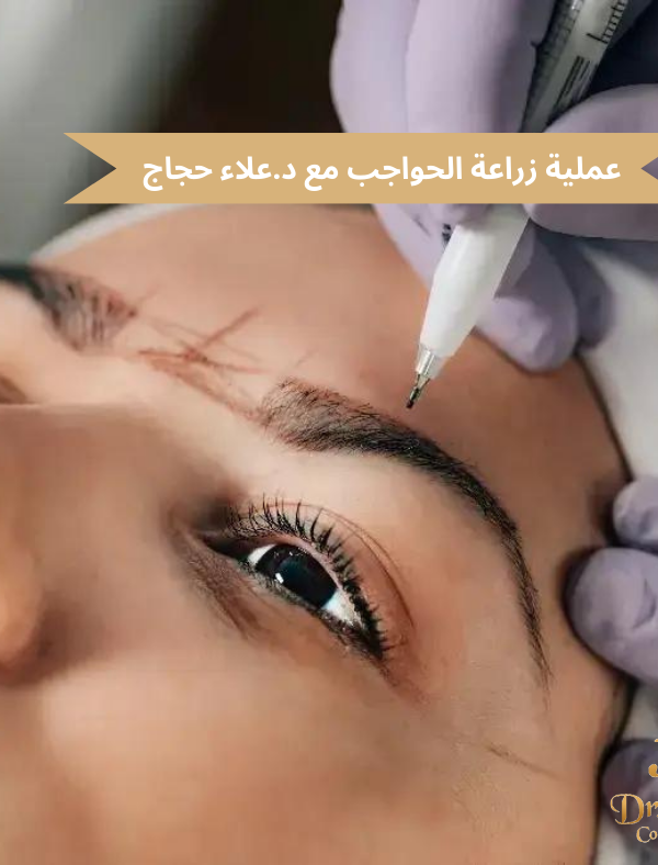 عملية زراعة الحواجب