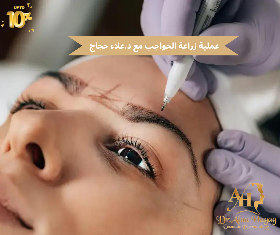 عملية زراعة الحواجب