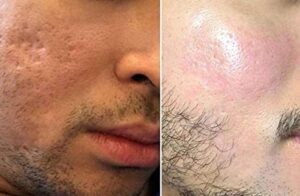 فوائد الديرما بن للبشره