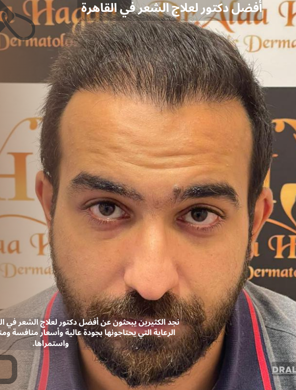 أفضل دكتور لعلاج الشعر في القاهرة