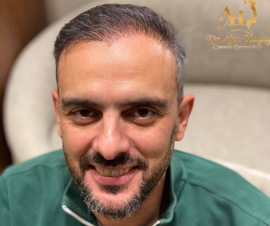 نتائج زراعة الشعر