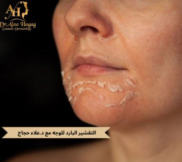 التقشير البارد للوجه