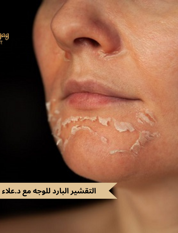 التقشير البارد للوجه