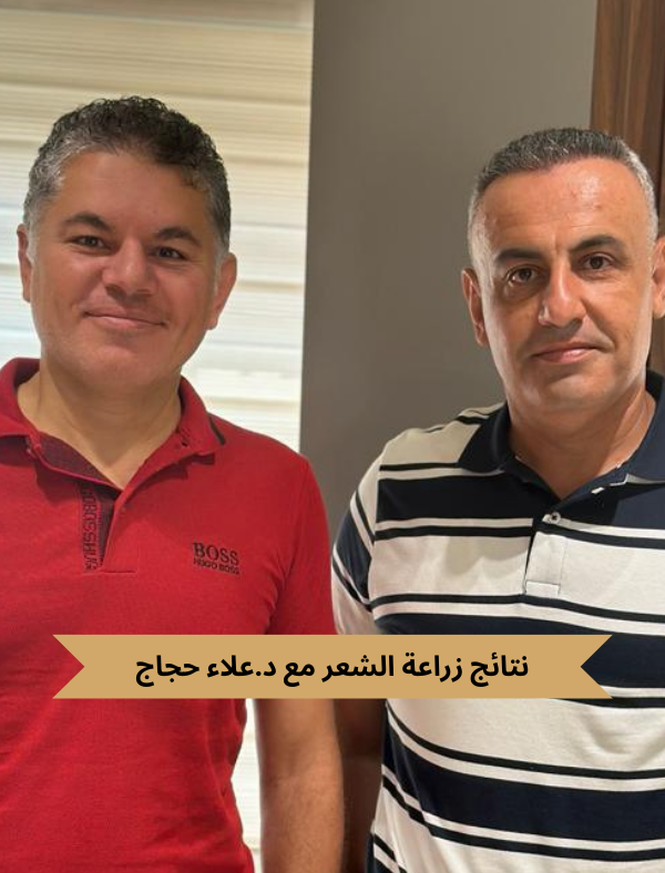 نتائج زراعة الشعر
