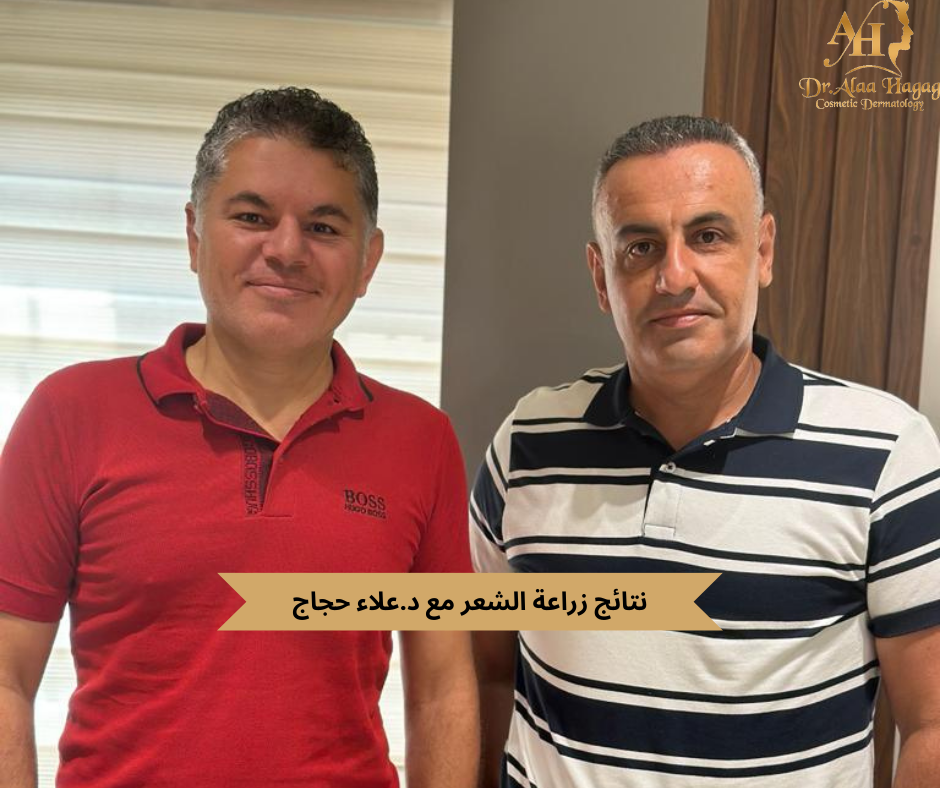 نتائج زراعة الشعر