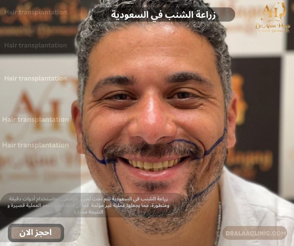 زراعة الشنب في السعودية