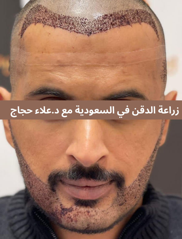 زراعة الدقن في السعودية