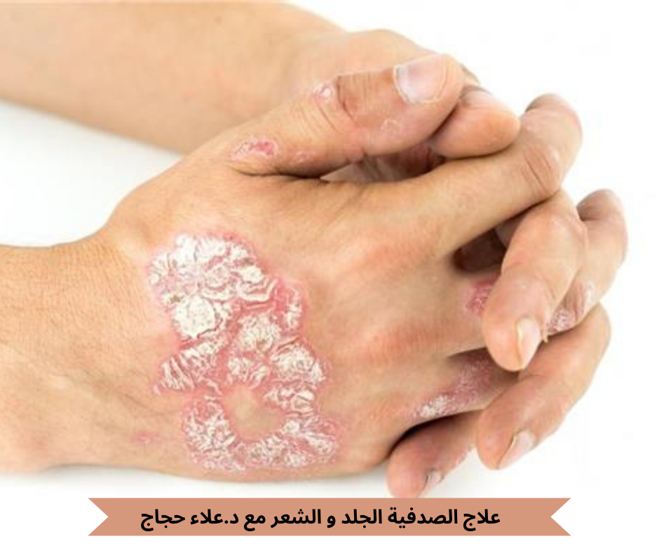 علاج الصدفية الجلد و الشعر مع د.علاء حجاج