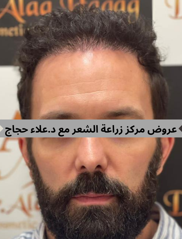 مركز زراعة الشعر